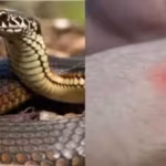 Snake bites MP woman 5 times in 2 minutes; 35 injections save her life | Bhopal News